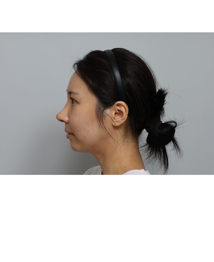 Korean-Style Rhinoplasty
