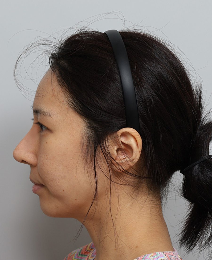 Non-Surgical Rhinoplasty (Nose Filler)