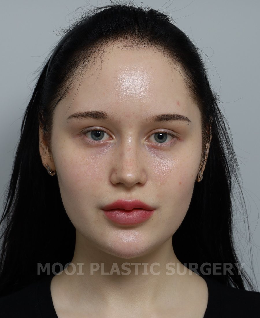 Bridge Rhinoplasty